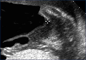 Ultrasound Image of amniocentesis amniodrain