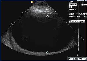 Ultrasound image of amniocentesis amniodrainage
