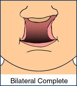 Medical illustration of a complete bilateral