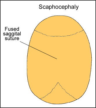 Medical illustration of scaphocephaly